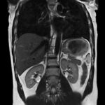 MRI ABDOMEN AND PELVIS1