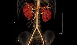Abdominal CT angiography