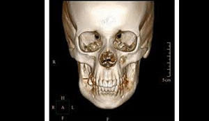 CT 3D Skull