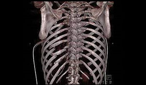 CT 3D rib cage