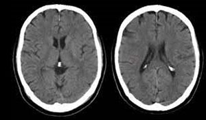 CT scan brain axial images