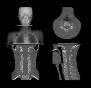 CT scan NECK2